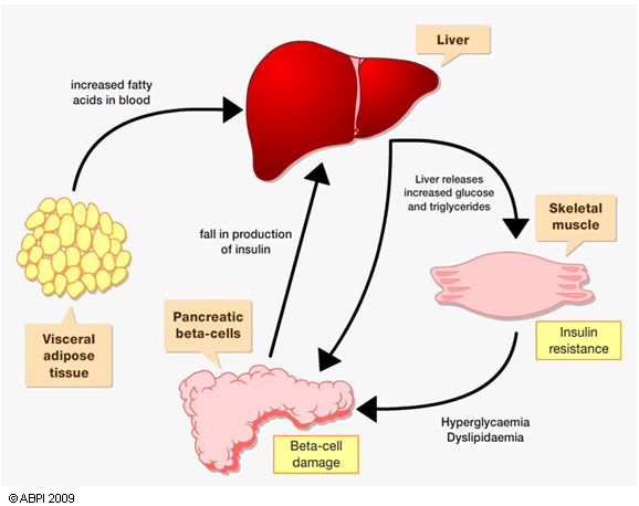 causes of type 2 diabetes